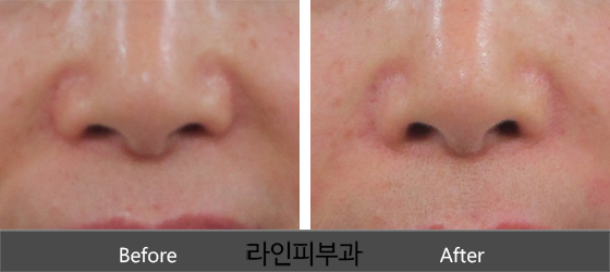 팔자필러