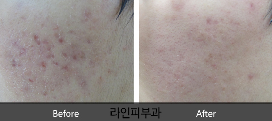 여드름자국 치료