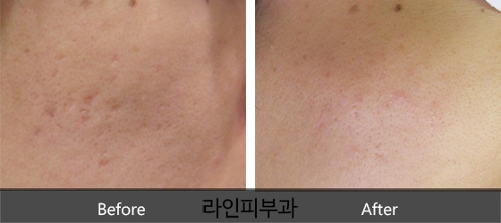 여드름흉터 치료
